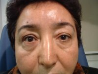 Proteză oftalmică, instalarea de proteze în Turcia