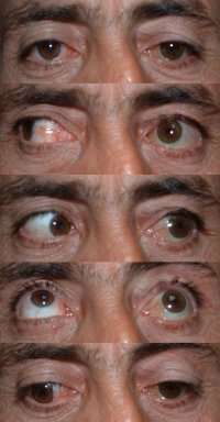 Proteză oftalmică, instalarea de proteze în Turcia