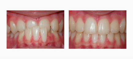 Глибокий прикус - як виправити