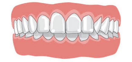 Глибокий прикус - як виправити