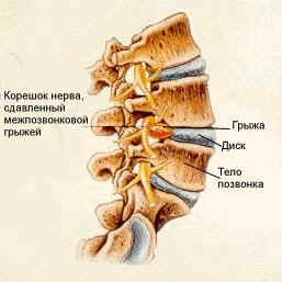 Herniated cauze de disc, simptome, tratamentul herniei lombare și de col uterin