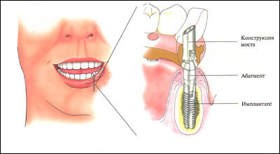 Implantarea dinților, instrucțiuni pentru pacienți, implanturi dentare