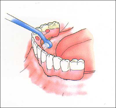 Implantarea dinților, instrucțiuni pentru pacienți, implanturi dentare