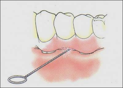 Implantarea dinților, instrucțiuni pentru pacienți, implanturi dentare
