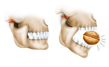 dislocarea mandibulei