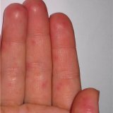 Cum să tratați eczemele pe mâini - bisturiu - informații medicale și portal educațional