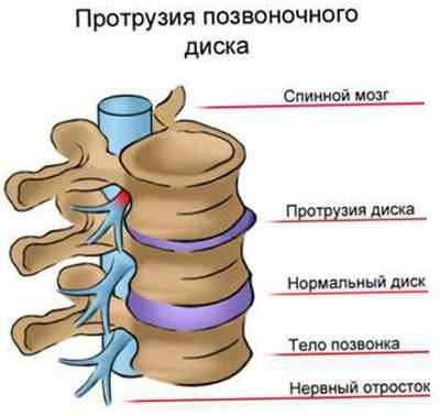 Cum să protejeze coloana vertebrală de hernia intervertebrală, tactica tratamentului, răspunsurile doctorului ortopedic