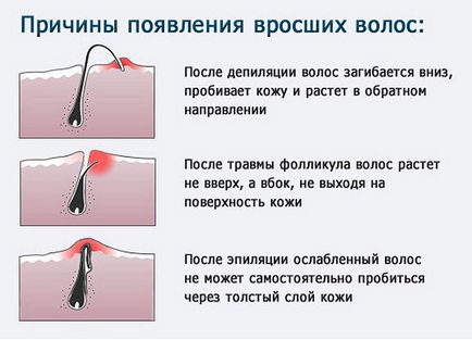 Як прибрати врослий волосся на нозі в домашніх умовах - врослі волосся на ногах - що робити, фото