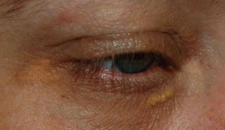 Hogyan lehet eltávolítani a talkum szem alatt és a szemhéjon