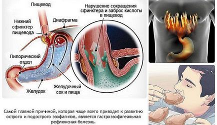 Candidoza cu HIV - cât timp trăiesc cu boala la SIDA