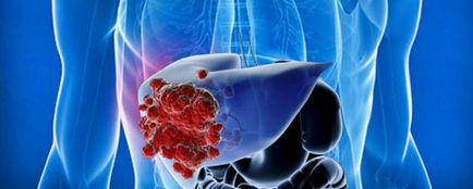 Simptome și tratament pentru carcinomul hepatic