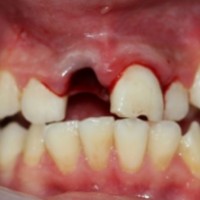Клінічний приклад відстроченої реплантації зуба у дитини, лікування зубів
