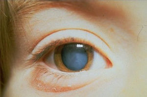 Куряча сліпота у людини - чому виникає ця хвороба