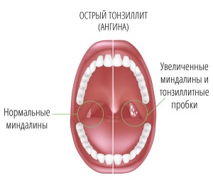Лікування і причини гнійних пробок в горлі в москві в клініці - лікар лор