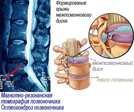 Tratamentul și prevenirea osteocondrozei