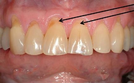 Tratamentul cariilor radicale - diagnostic, terapie, prevenire