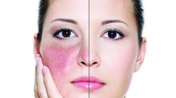 Tratamentul cu rosacea cu un laser pe fata, in centrul frumusetii laserului cu medicina estetica