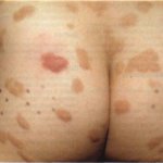 Mastocitoza, urticaria pigmentară, pete și cum să le eliminați