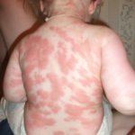 Mastocitoza, urticaria pigmentară, pete și cum să le eliminați