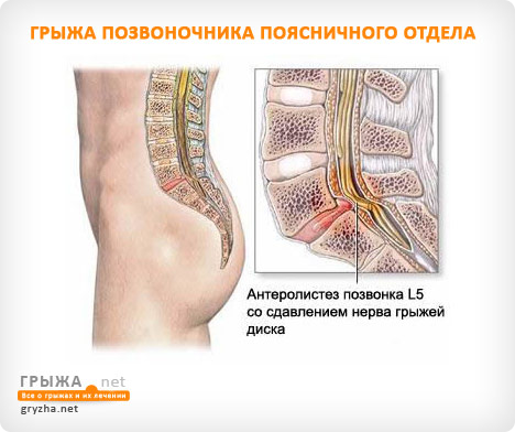 Herniul lombar intervertebral
