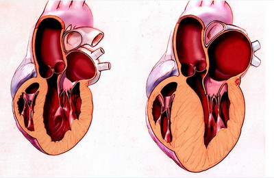 Myocardium și inima ghid pentru pacient