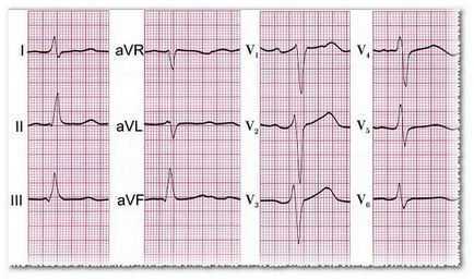 Myocardium și inima ghid pentru pacient