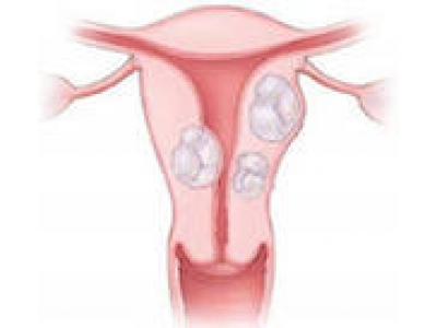 Iomul uterului în combinație cu trăsăturile de tratament cu adenomie