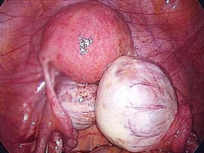 Iomul uterului în combinație cu trăsăturile de tratament cu adenomie