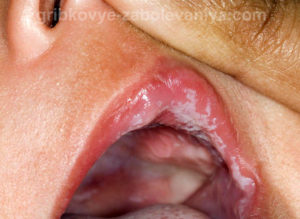 Afumă pe buzele copilului cauzează, simptome, cum să tratăm