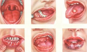 Afumă pe buzele unui copil simptome, cauze, tratament