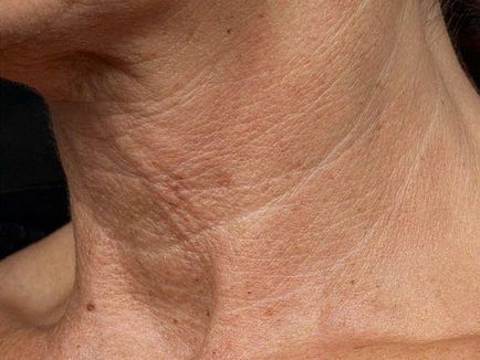 Ridurile în jurul gâtului sunt motivele pentru aspectul lor, cum să curățați cu Botox, fotografii și sfaturi video