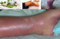 Van gyógymód a rosacea (acne rosacea) népi jogorvoslati