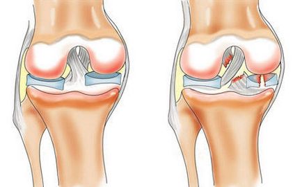 Datorită caracteristicilor și avantajelor comune ale genunchiului