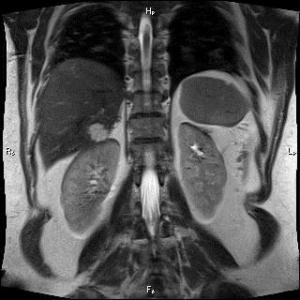 MRI на корема