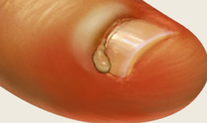 Un abces pe deget în apropierea tratamentului unghiilor