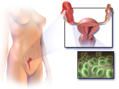 Adenomioză focală a cauzelor uterului, simptome, tratament