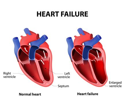 Dispnee cu cauze de insuficiență cardiacă și tratament