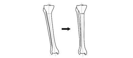 Operația de corectare a curburii picioarelor poate fi evitată