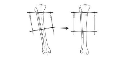 Operația de corectare a curburii picioarelor poate fi evitată