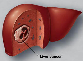 Etiologia tumorilor hepatice, patogeneza, clinica (simptomele) și tratamentul