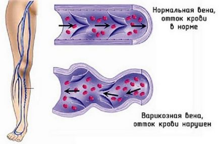 Umflarea picioarelor la femei după 50 până la 55 de ani de cauză