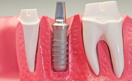 Відсутність зубів топ-8 негативних наслідків, клініка санація