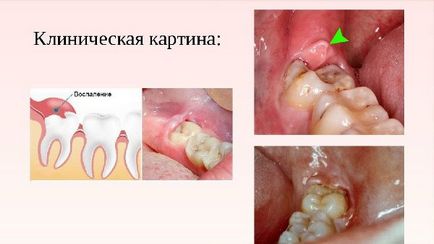 Pericoronarita clasificare, diagnostic, metode de tratament și tactici