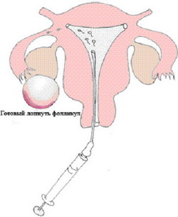 Centru perinatal - inseminare artificială cu sperma soțului sau a donatorului (iism, isis)