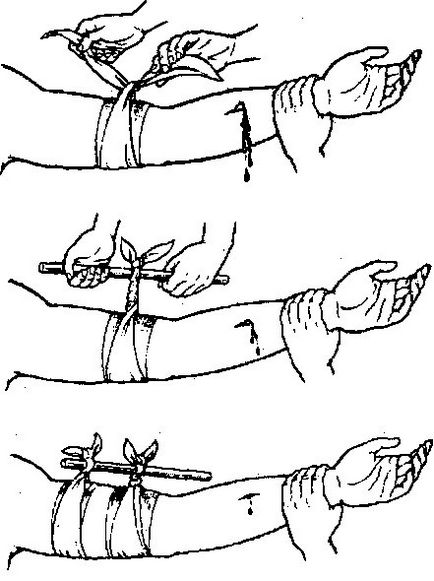 Primul ajutor pentru sângerarea instrucțiunilor scurte și detaliate