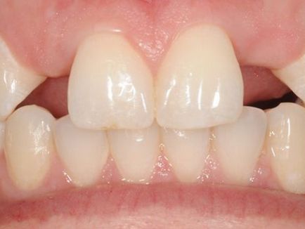 Adentia primară sau secundară - absența completă sau parțială a dinților la copii și adulți
