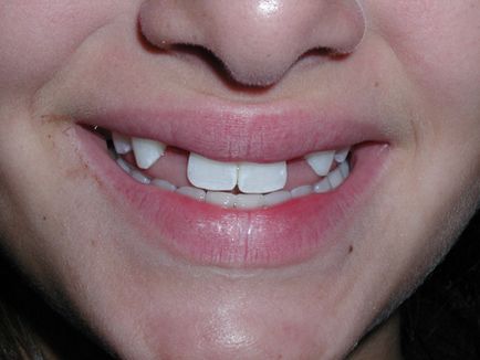 Первинна або вторинна адентія - повна або часткова відсутність зубів у дітей і дорослих