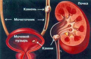 Râul nisip - simptome, cauze și tratament, diagnosticul prezenței nisipului în rinichi