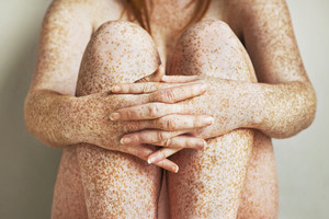 Pigmentarea pielii pe picioare - ziua femeii