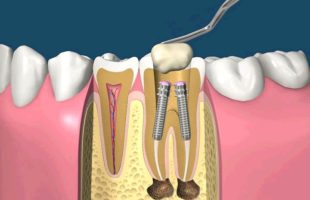Пластмасові коронки на жувальні зуби, плюси і мінуси